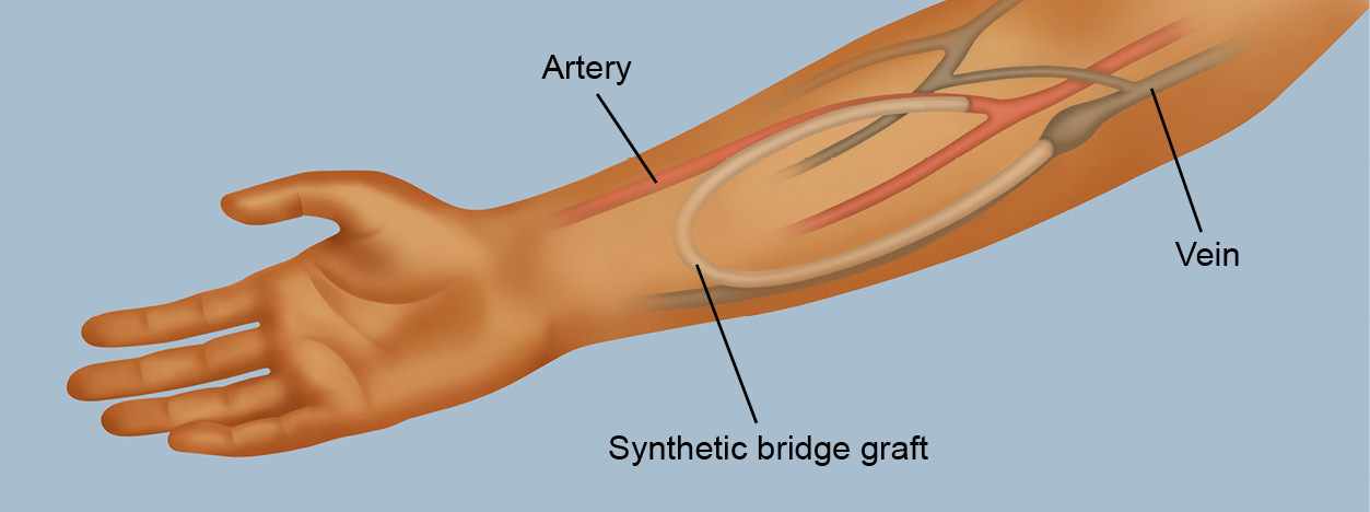 Illustration of an AV fistula in a forearm: shows the connection of vein and artery.